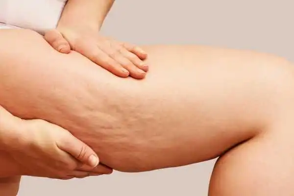 Image of woman showing leg with cellulite Tilehurst
