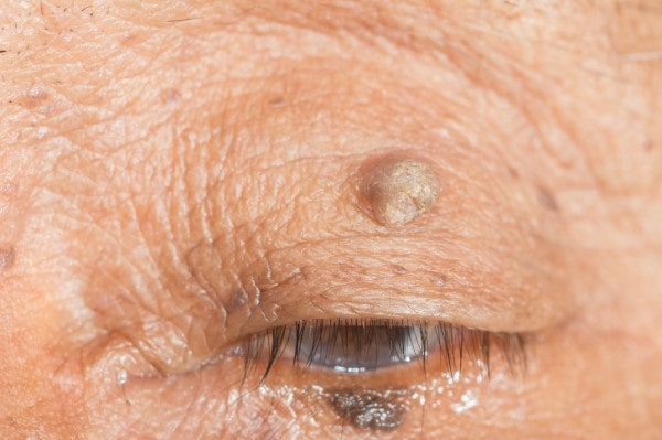 Skin imperfections Tilehurst - Cryopen is fast and effective book in today!
