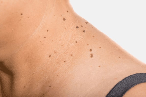 Are you looking for easy skin tag removal Tilehurst - then contact Spire today!