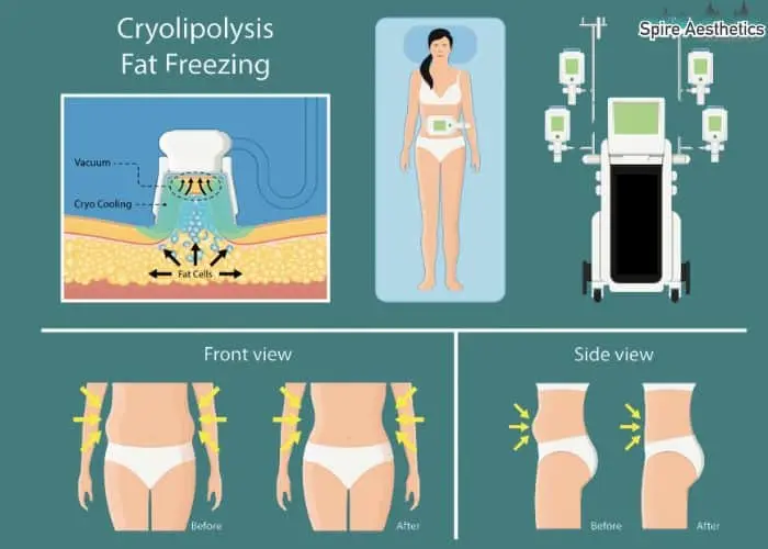 Fat freezing treatment Tilehurst benefits for competitions to remove stubborn fat deposits.