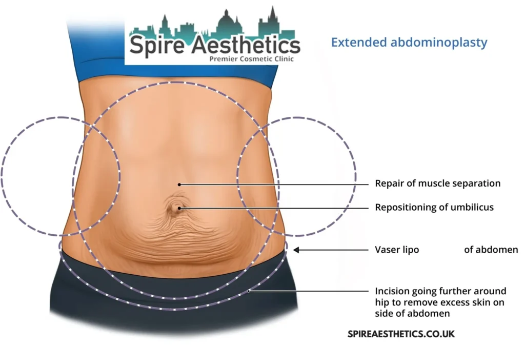 Understanding Loose Skin After Gastric Band Tilehurst Surgery and HIFU Treatment
