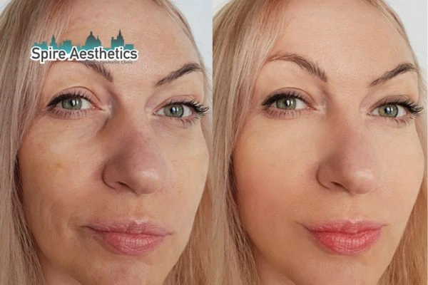 Morpheus8 Treatment Tilehurst Before & After Results