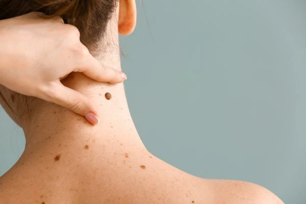 skin blemish removal Tilehurst treatment