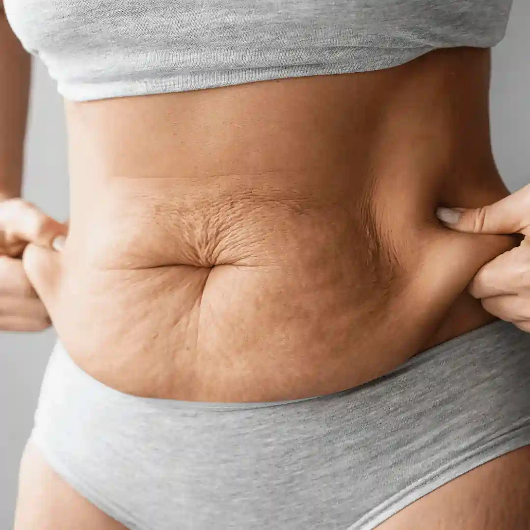 Is It Normal to Have Loose Skin After Pregnancy Tilehurst?