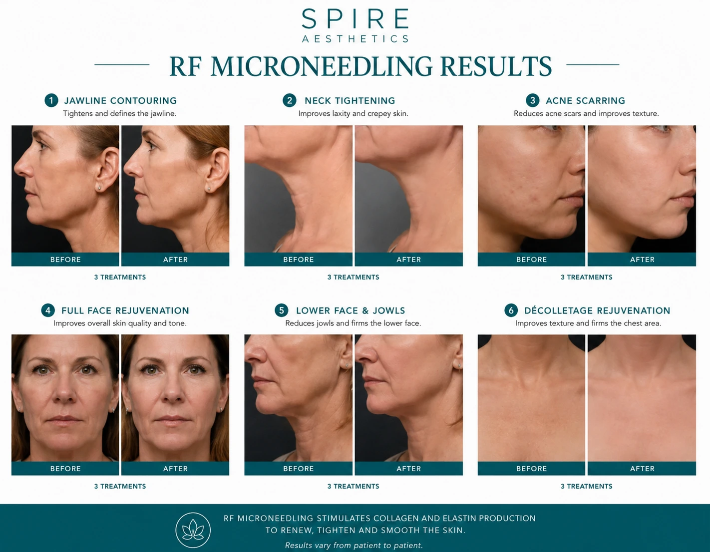 RF Microneedling Skin tightening Tilehurst results