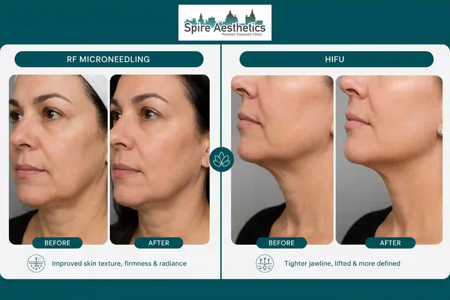 Can RF Microneedling and HIFU Be Combined Tilehurst?