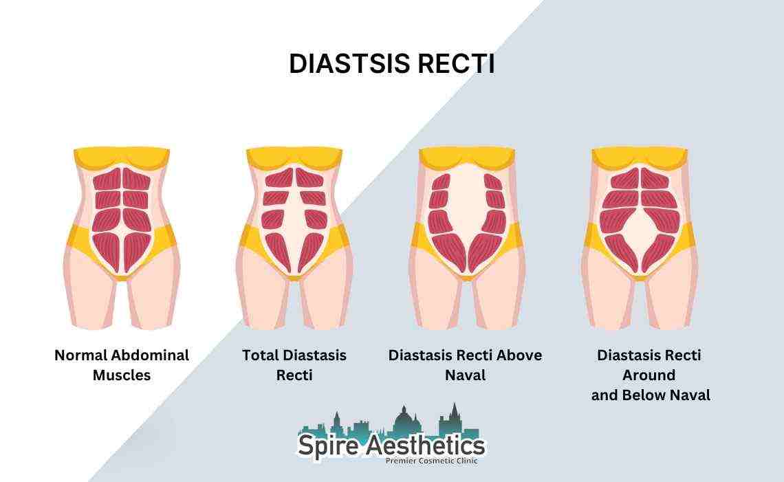 Is Non-Surgical Diastasis Recti Treatment Right for You? Common Concerns Answered Tilehurst